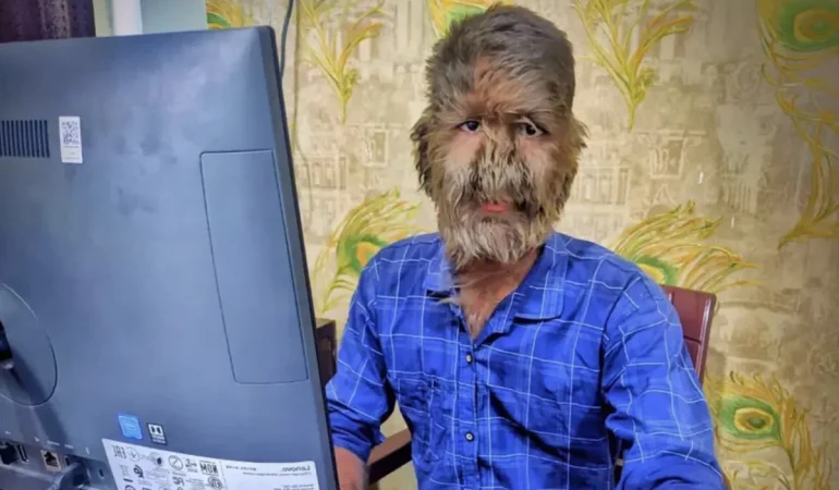 HİNDİSTANLI GENÇ “DÜNYANIN EN KILLI YÜZÜNE SAHİP İNSANI” OLARAK GUINNESS REKORLAR KİTABI’NA GİRDİ