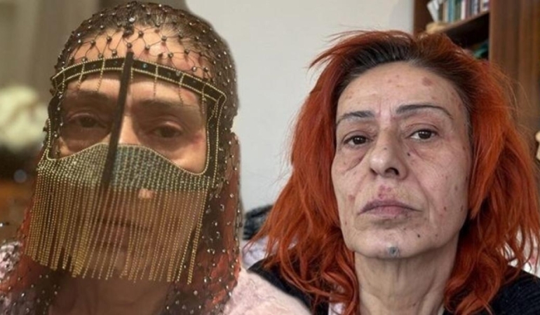 YILDIZ TİLBE’DEN YÜZÜNDEKİ KİMYASAL YANIKLARLA İLGİLİ YENİ AÇIKLAMA